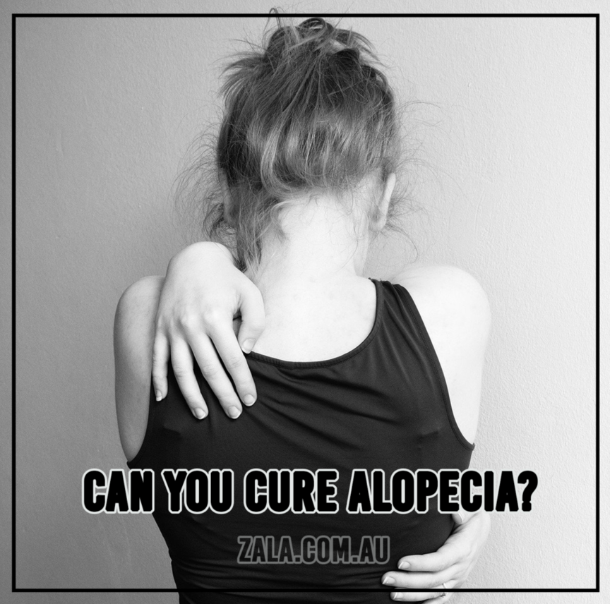 Can You Cure Alopecia?